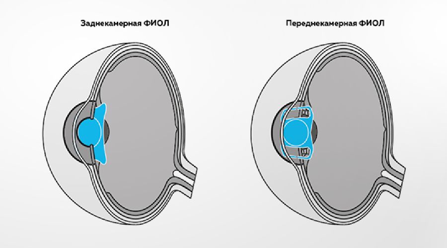 Иол в офтальмологии. Имплантация факичной интраокулярной линзы. Заднекамерные интраокулярные линзы. Что такое имплантация интраокулярной линзы (схема 1 - 